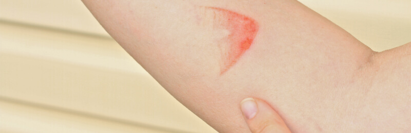 Closeup of steam burn on a person’s forearm